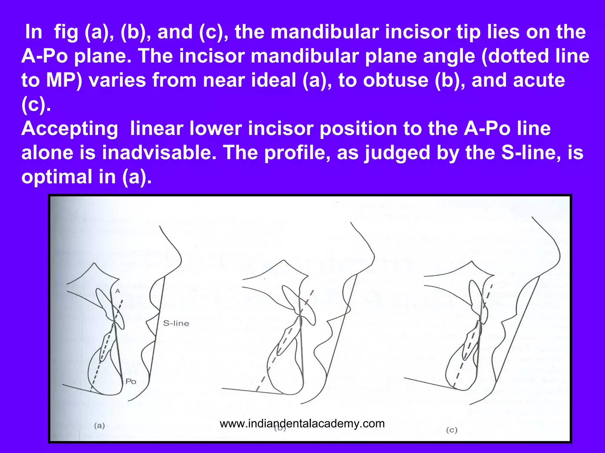 In fig (a), (b), and (c), the mandibular incisor tip lies on the
A-Po plane. The incisor mandibular plane angle (dotted line
to MP) varies from near ideal (a), to obtuse (b), and acute
(c).
Accepting linear lower incisor position to the A-Po line
alone is inadvisable. The profile, as judged by the S-line, is
optimal in (a).
www.indiandentalacademy.com
 