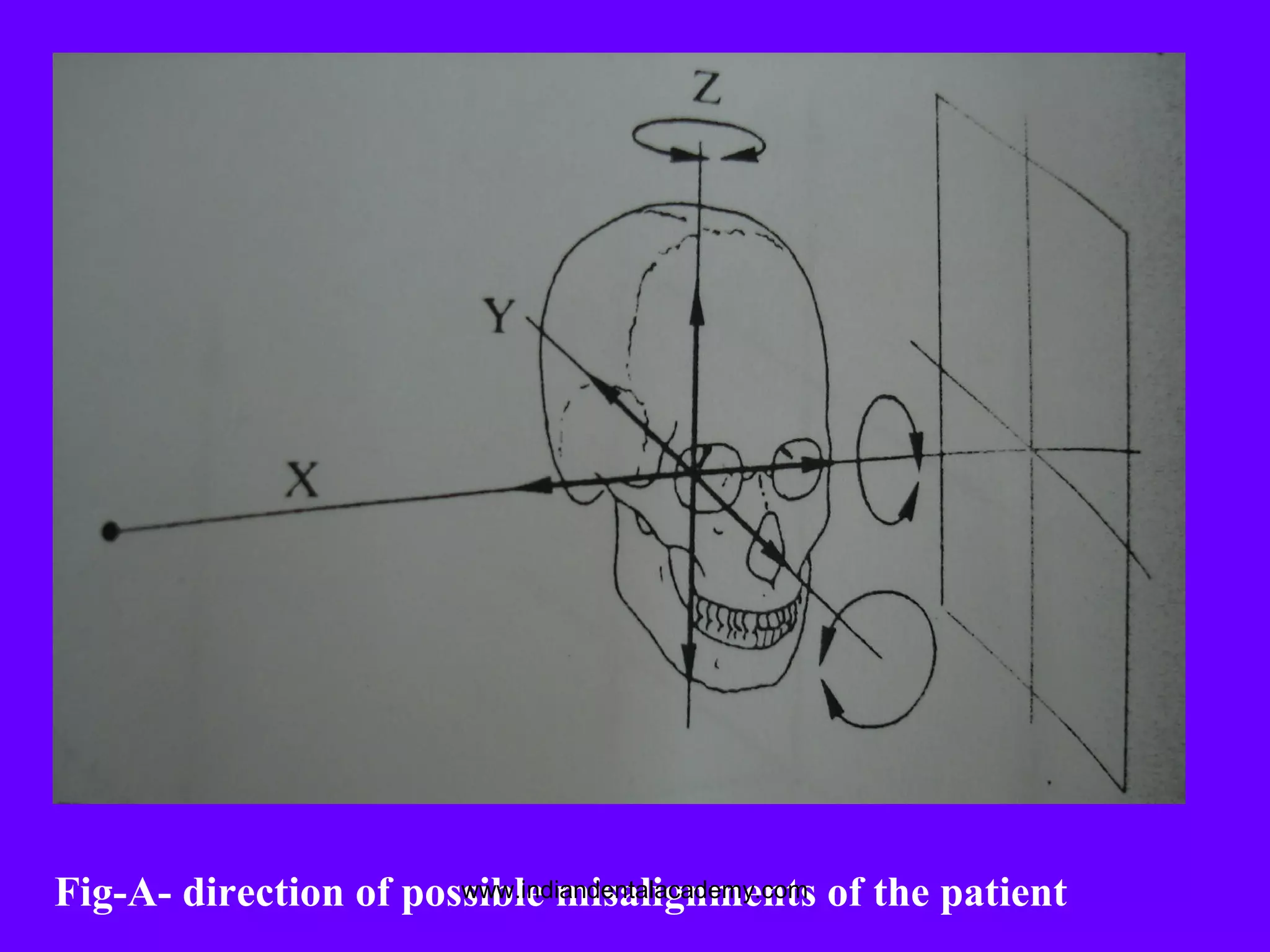 Fig-A- direction of possible misalignments of the patientwww.indiandentalacademy.com
 