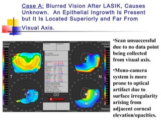Case A: Blurred Vision After LASIK, Causes
Unknown. An Epithelial Ingrowth Is Present
but It Is Located Superiorly and Far From
Visual Axis.
•Scan unsuccessful
due to no data point
being collected
from visual axis.
•Mono-camera
system is more
prone to optical
artifact due to
surface irregularity
arising from
adjacent corneal
elevation/opacities.
 