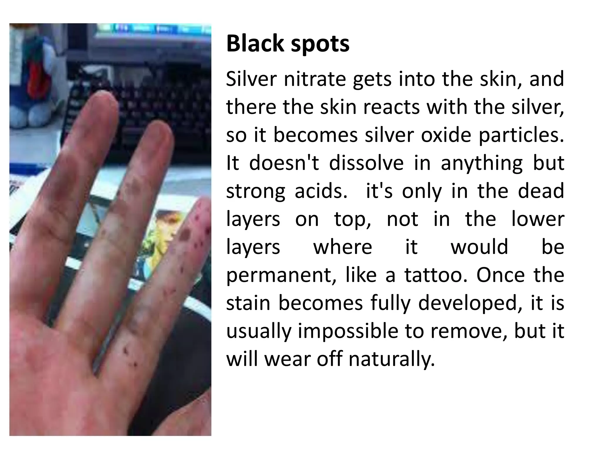 • Black spots
• Silver nitrate gets into the skin, and
there the skin reacts with the silver,
so it becomes silver oxide particles.
It doesn't dissolve in anything but
strong acids. it's only in the dead
layers on top, not in the lower
layers where it would be
permanent, like a tattoo. Once the
stain becomes fully developed, it is
usually impossible to remove, but it
will wear off naturally.
 
