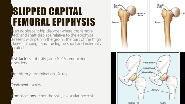 approach to Limping in pediatric | PPT
