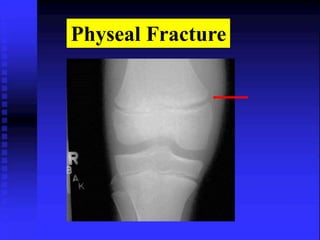 Physeal Fracture 
 