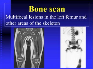 Bone scan 
Multifocal lesions in the left femur and 
other areas of the skeleton 
 