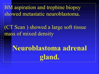 BM aspiration and trephine biopsy 
showed metastatic neuroblastoma. 
(CT Scan ) showed a large soft tissue 
mass of mixed density 
Neuroblastoma adrenal 
gland. 
 