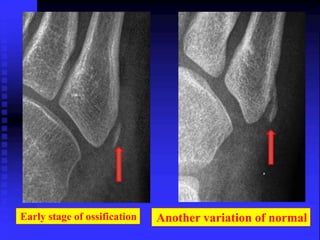 Early stage of ossification Another variation of normal 
 