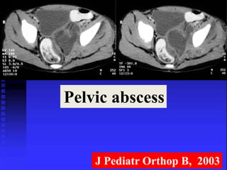 Pelvic abscess 
J Pediatr Orthop B, 2003 
 