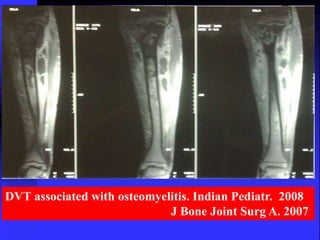 DVT associated with osteomyelitis. Indian Pediatr. 2008 
J Bone Joint Surg A. 2007 
 