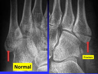 Normal 
Fracture 
 