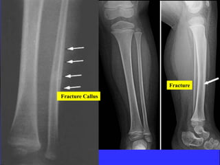 Fracture 
Fracture Callus 
 