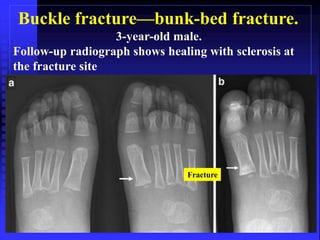 Buckle fracture—bunk-bed fracture. 
3-year-old male. 
Follow-up radiograph shows healing with sclerosis at 
the fracture site 
Fracture 
 