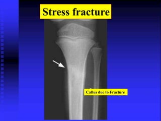 Stress fracture 
Callus due to Fracture 
 