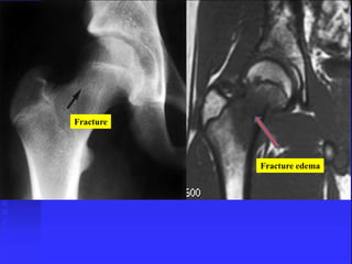Fracture 
Fracture edema 
 