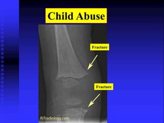 Child Abuse 
Fracture 
Fracture 
 