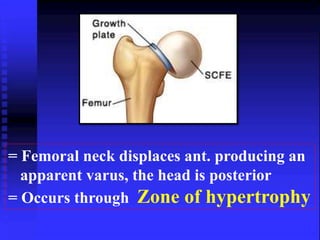 = Femoral neck displaces ant. producing an 
apparent varus, the head is posterior 
= Occurs through Zone of hypertrophy 
 