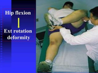 Hip flexion 
Ext rotation 
deformity 
 