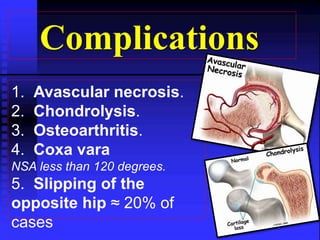 Complications 
1. Avascular necrosis. 
2. Chondrolysis. 
3. Osteoarthritis. 
4. Coxa vara 
NSA less than 120 degrees. 
5. Slipping of the 
opposite hip ≈ 20% of 
cases 
 