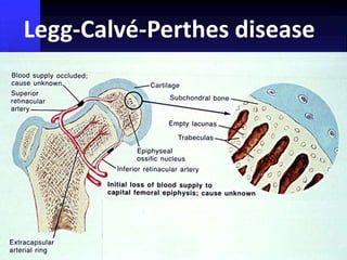 Legg-Calvé-Perthes disease 
 