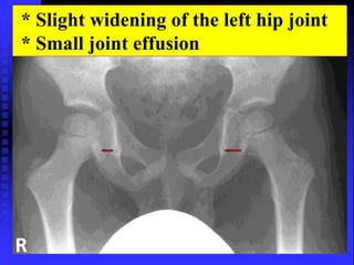 * Slight widening of the left hip joint 
* Small joint effusion 
R 
 