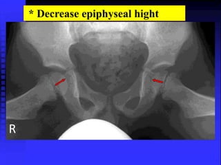 * Decrease epiphyseal hight 
R 
 