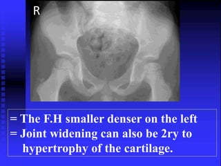 R 
= The F.H smaller denser on the left 
= Joint widening can also be 2ry to 
hypertrophy of the cartilage. 
 