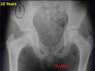 10 Years 
Perthes 
 