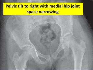 Pelvic tilt to right with medial hip joint 
space narrowing 
 