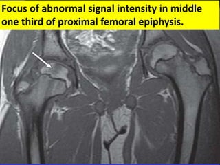 Focus of abnormal signal intensity in middle 
one third of proximal femoral epiphysis. 
 