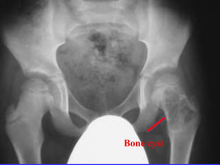 Bone cyst 
 