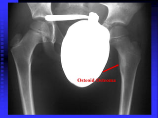 Osteoid Osteoma 
 