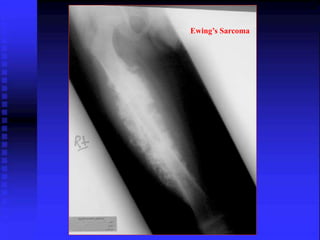 Ewing’s Sarcoma 
 