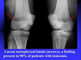 Lucent metaphyseal bands (arrows), a finding 
present in 90% of patients with leukemia. 
 