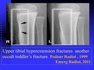 Upper tibial hyperextension fractures another 
occult toddler’s fracture. Pediatr Radiol , 1999 
Emerg Radiol, 2011 
 