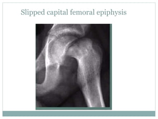Slipped capital femoral epiphysis
 