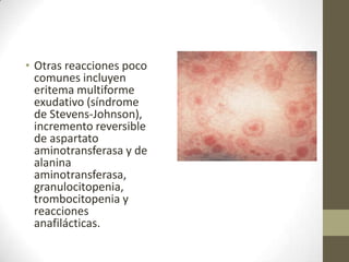 • Otras reacciones poco
comunes incluyen
eritema multiforme
exudativo (síndrome
de Stevens-Johnson),
incremento reversible
de aspartato
aminotransferasa y de
alanina
aminotransferasa,
granulocitopenia,
trombocitopenia y
reacciones
anafilácticas.

 