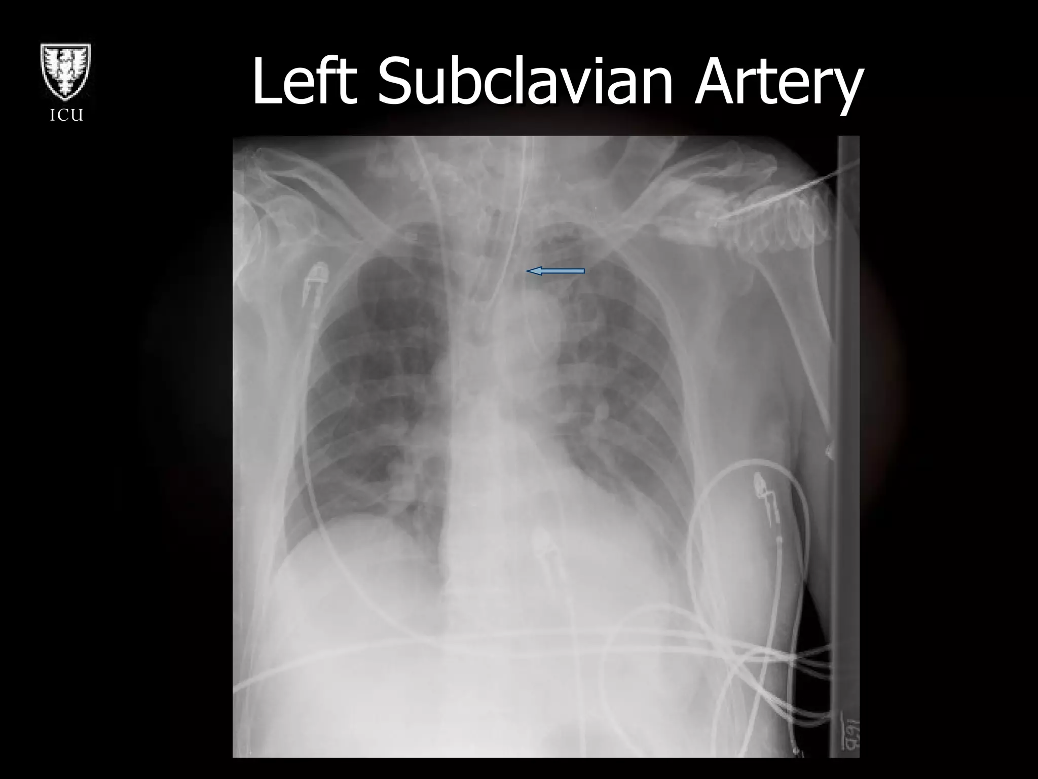 Left Subclavian Artery 