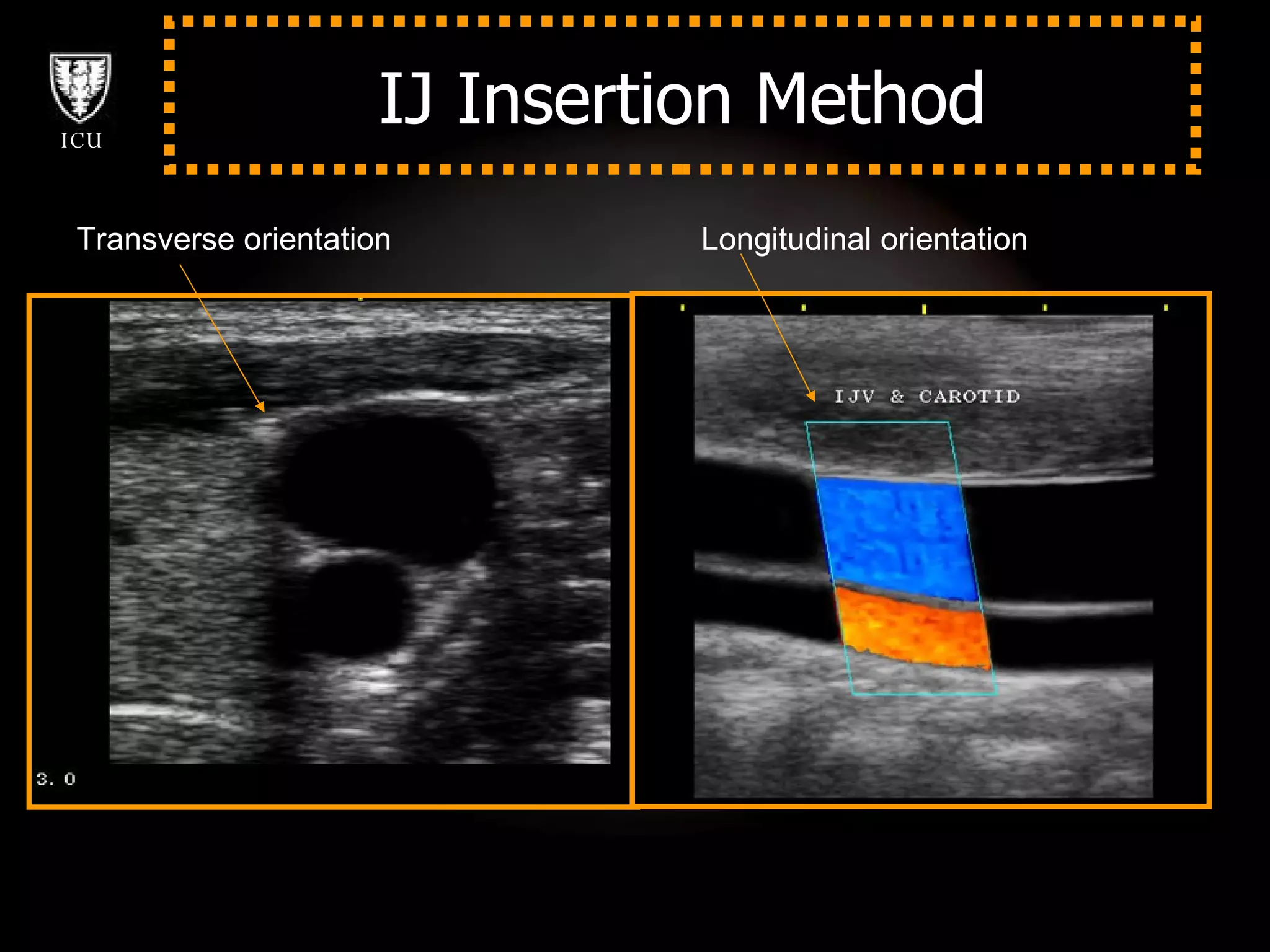 IJ Insertion Method Transverse orientation Longitudinal orientation 