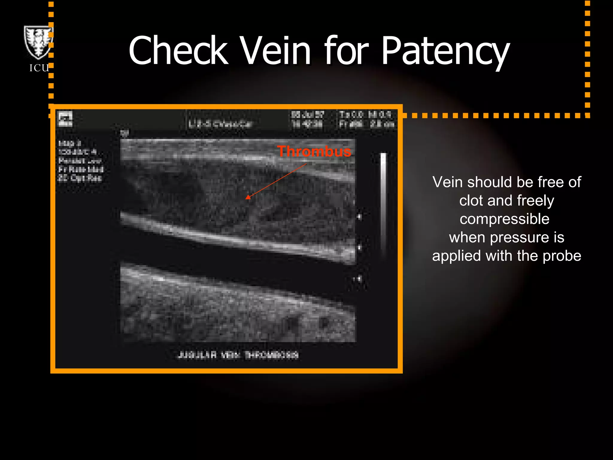 Check Vein for Patency Thrombus Vein should be free of clot and freely compressible  when pressure is applied with the probe 