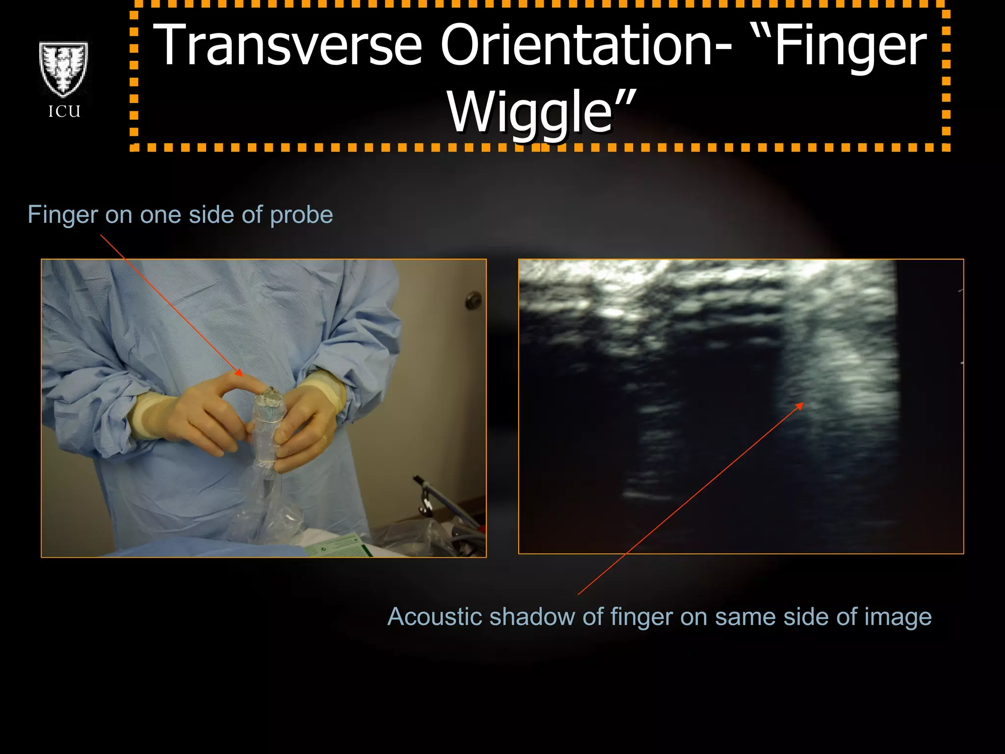 Transverse Orientation- “Finger Wiggle” Finger on one side of probe  Acoustic shadow of finger on same side of image 