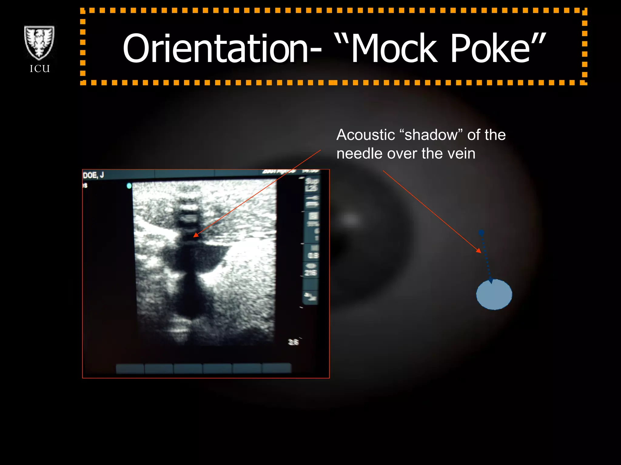 Orientation- “Mock Poke” Acoustic “shadow” of the  needle over the vein 