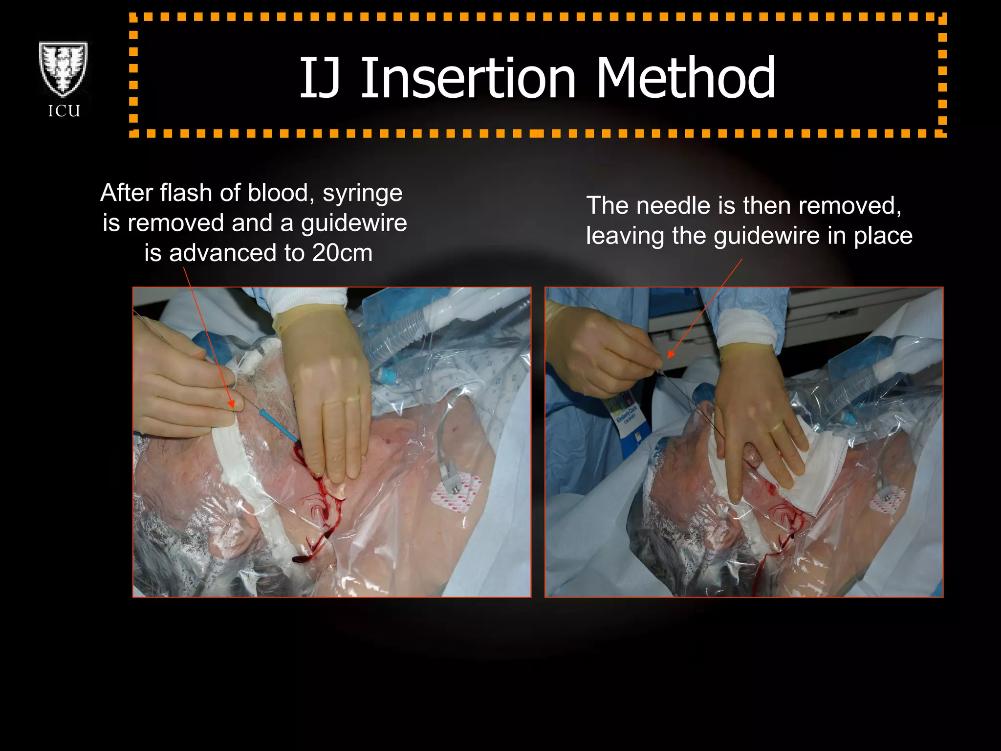 IJ Insertion Method After flash of blood, syringe  is removed and a guidewire is advanced to 20cm The needle is then removed,  leaving the guidewire in place 