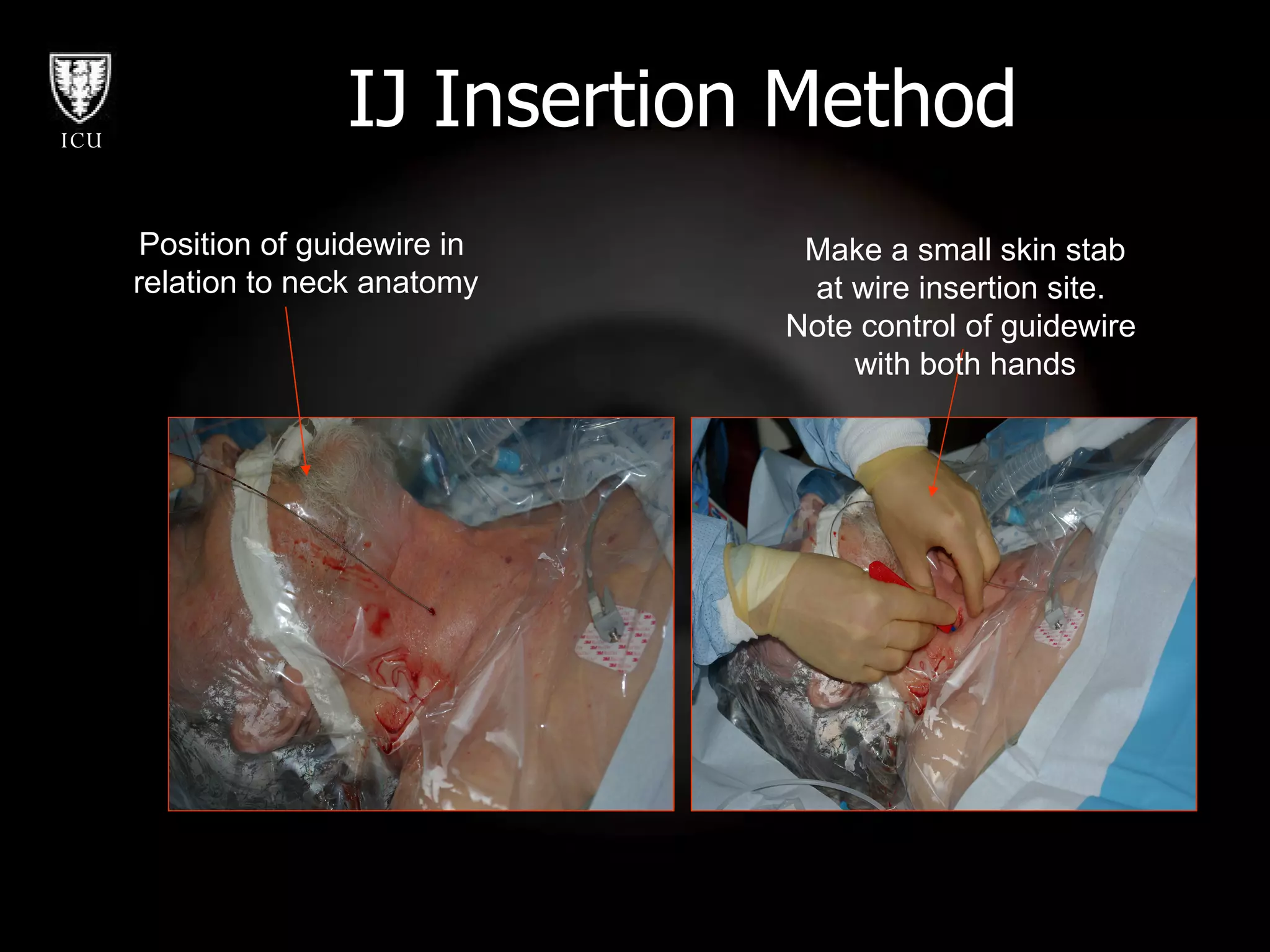 IJ Insertion Method Position of guidewire in  relation to neck anatomy Make a small skin stab at wire insertion site.  Note control of guidewire  with both hands 