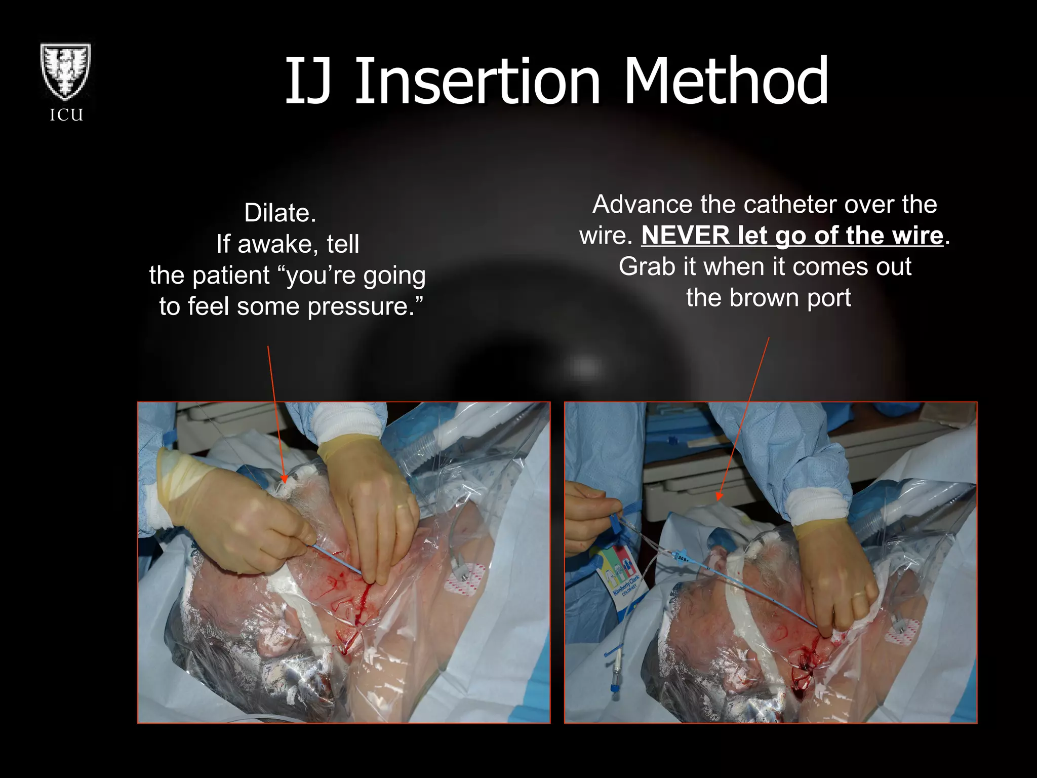 IJ Insertion Method Dilate.  If awake, tell the patient “you’re going to feel some pressure.” Advance the catheter over the wire.  NEVER let go of the wire .  Grab it when it comes out the brown port 
