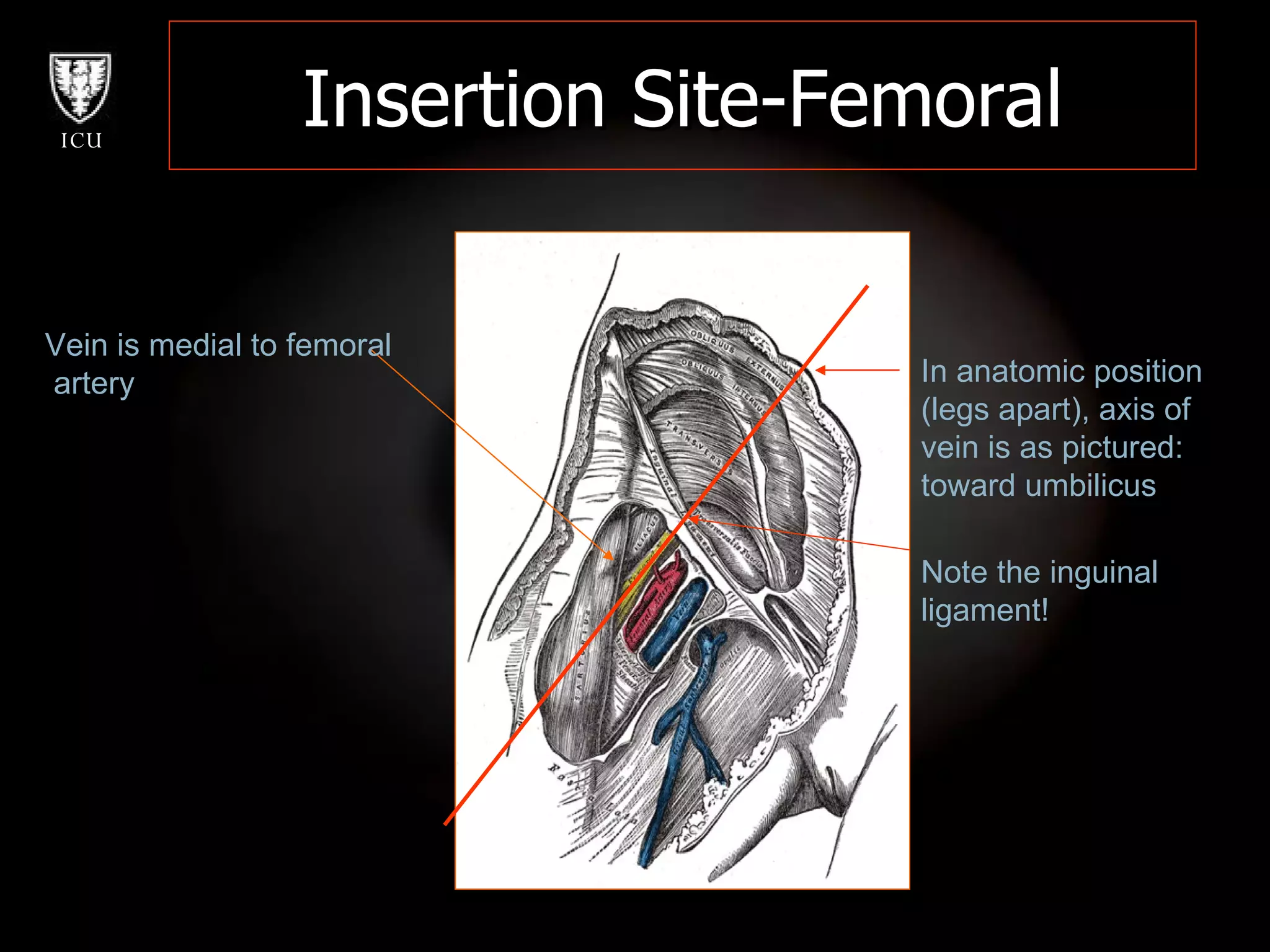 Insertion Site-Femoral Vein is medial to femoral artery In anatomic position  (legs apart), axis of  vein is as pictured:  toward umbilicus Note the inguinal  ligament! 