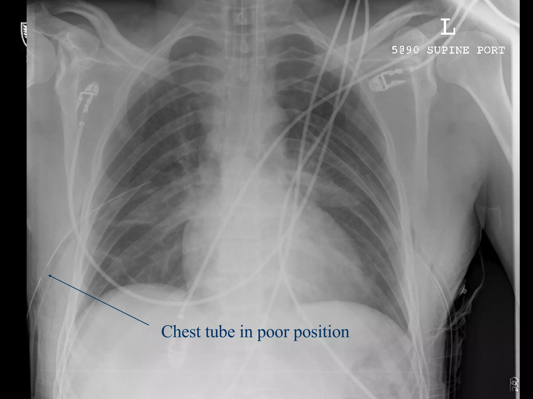 Chest tube in poor position 