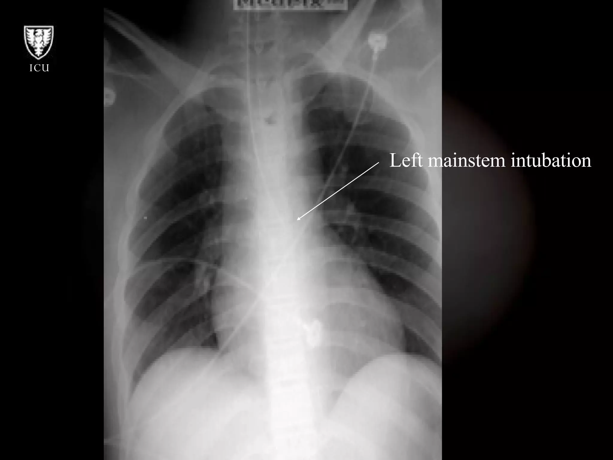 Left mainstem intubation 