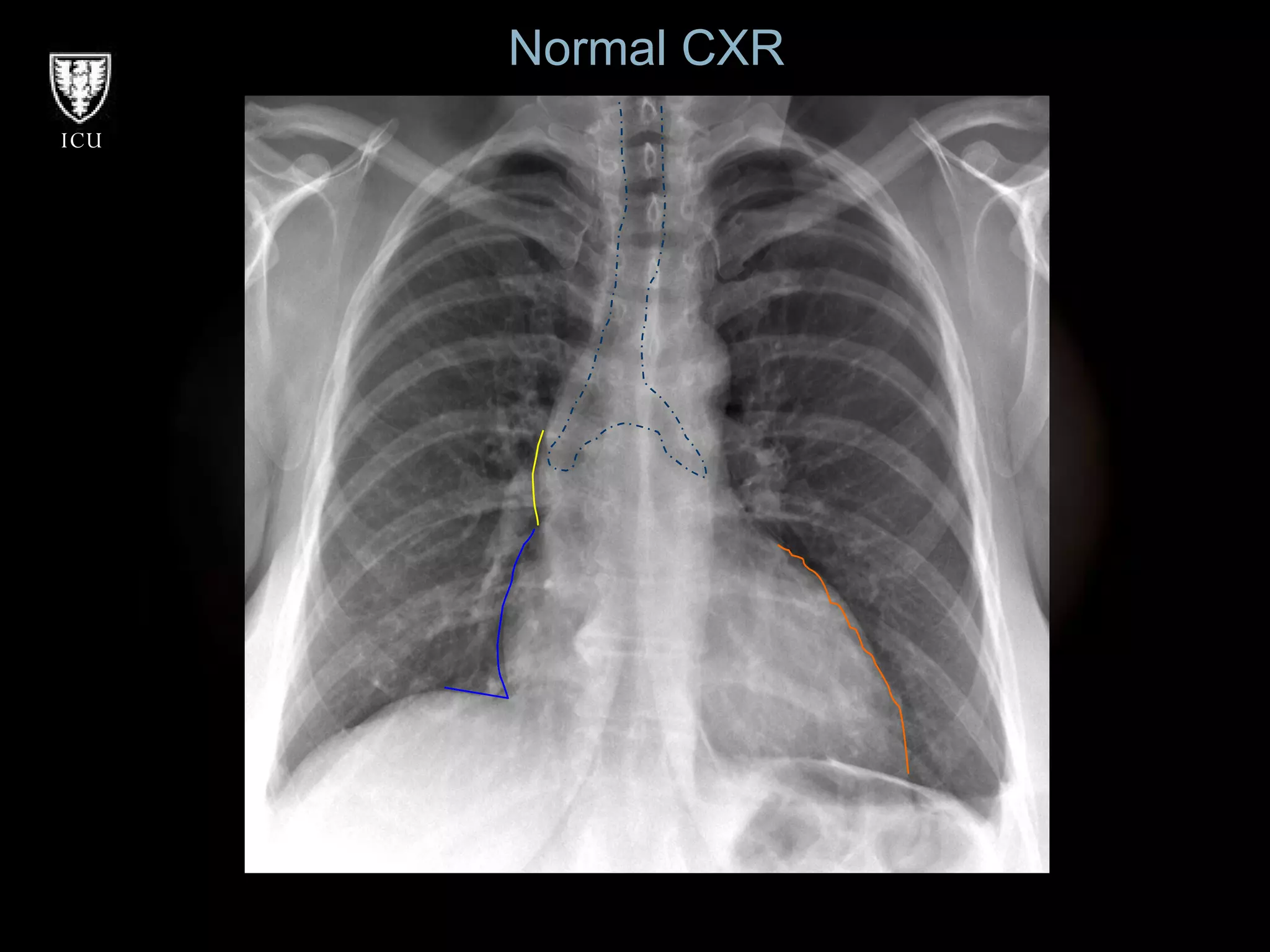Normal CXR 
