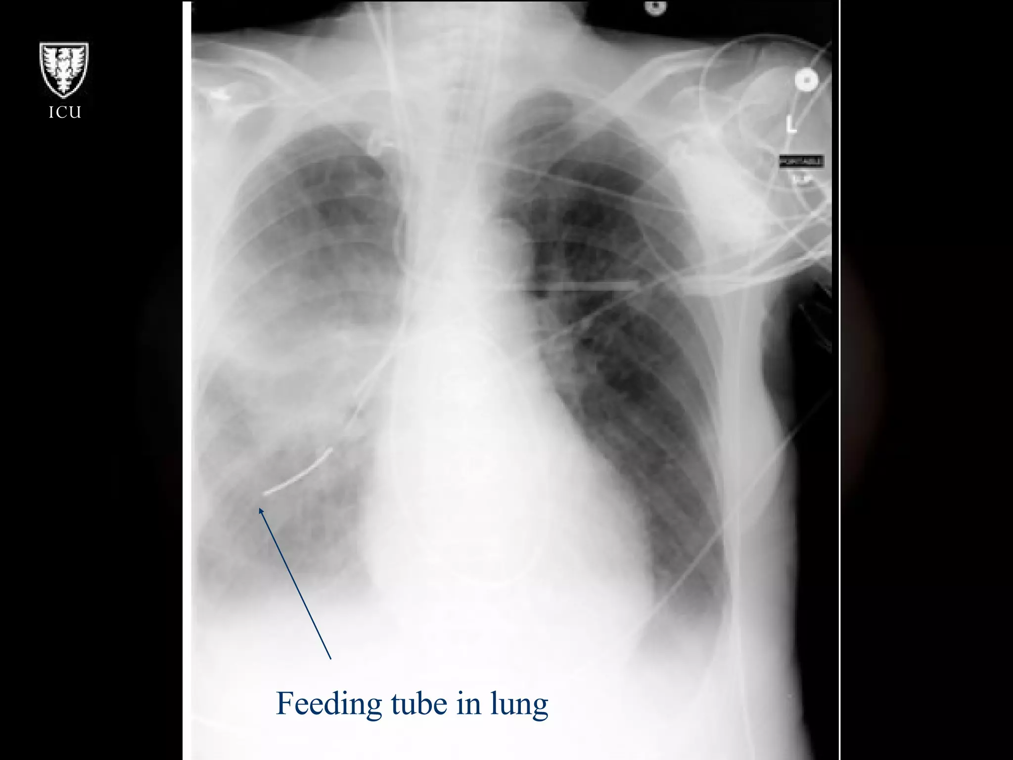 Feeding tube in lung 