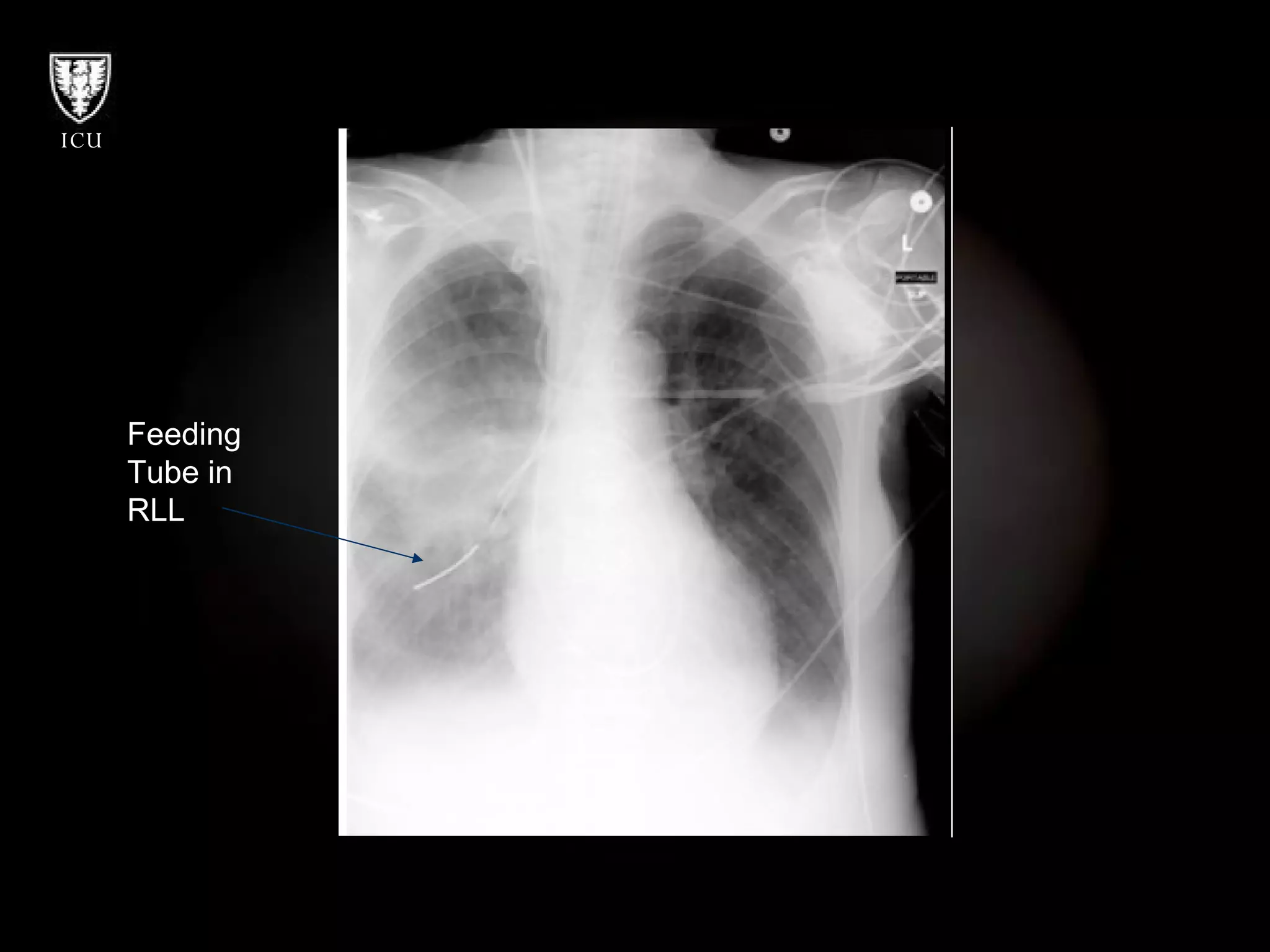 Feeding  Tube in  RLL 