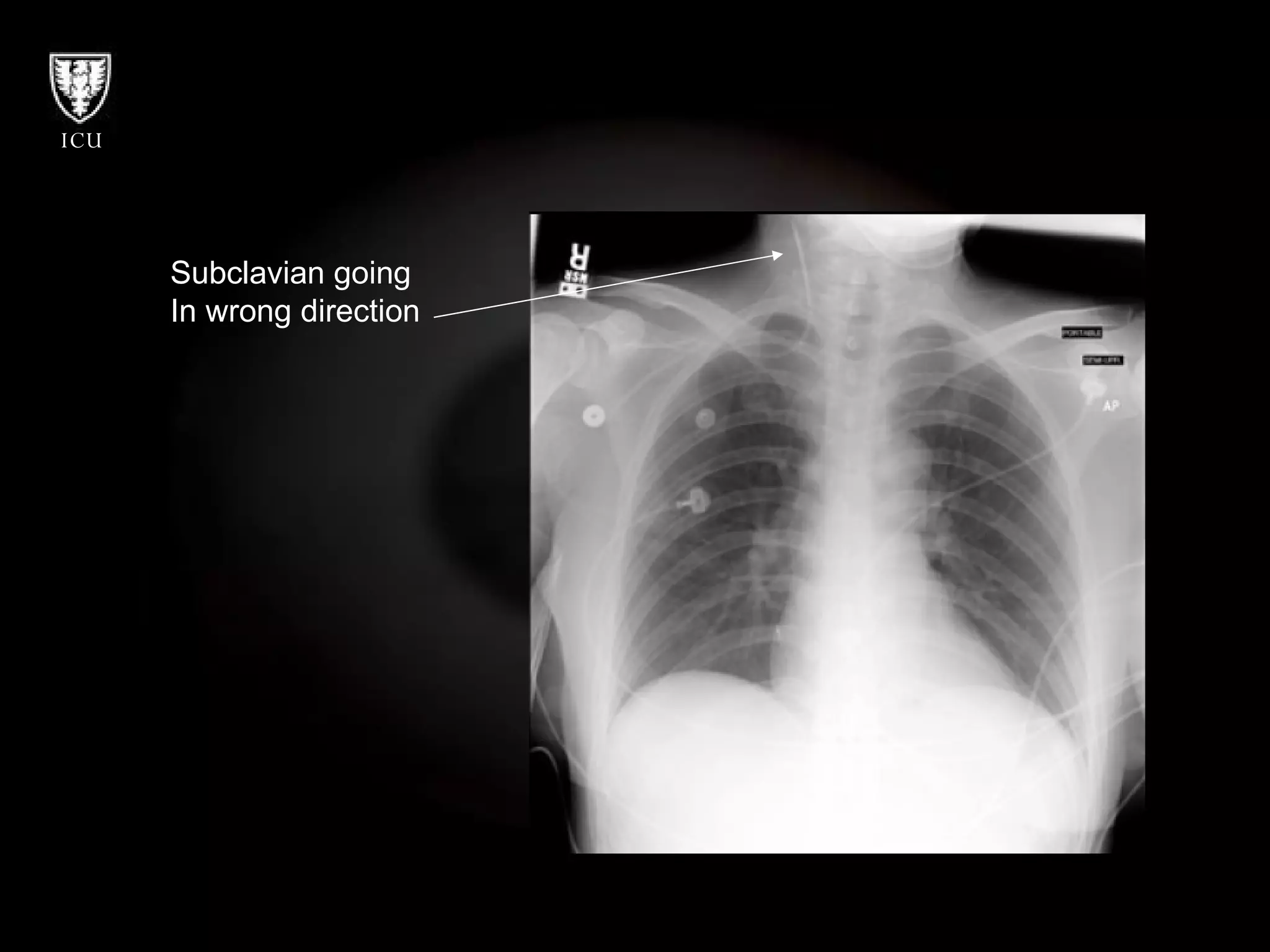 Subclavian going  In wrong direction 