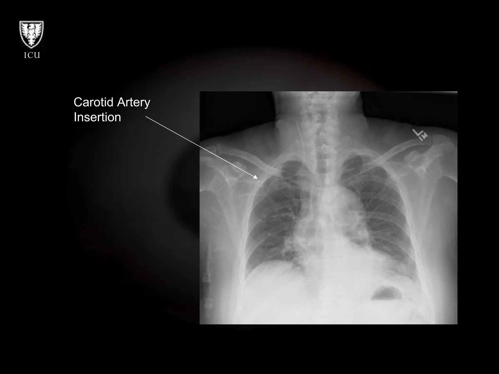 Carotid Artery  Insertion 